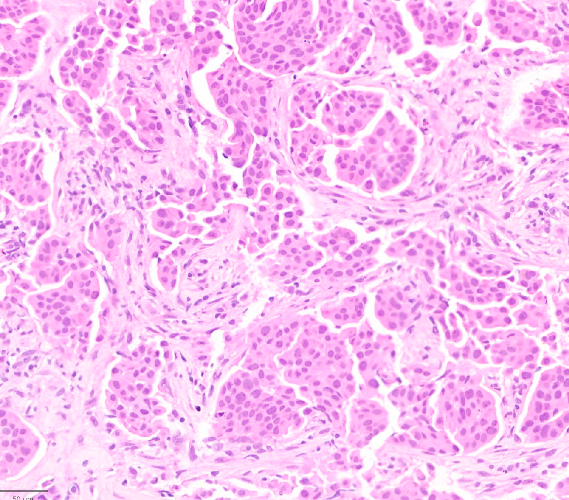 Representative H&E-stained breast cancer tissue